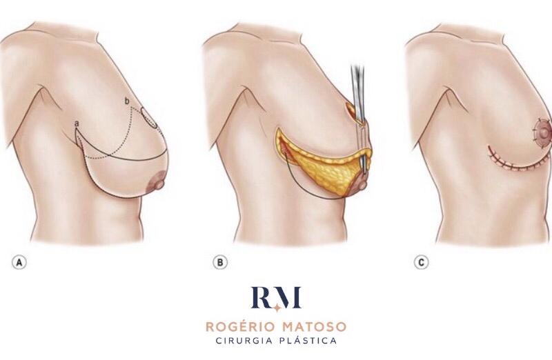 Nem todas as mulheres desejam aumentar os seios  • - Dr. Rogério Matoso -  Cirurgião Plástico